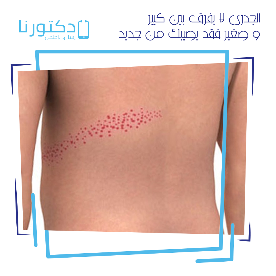 الجدرى المائى