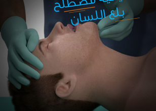 بلع اللسان