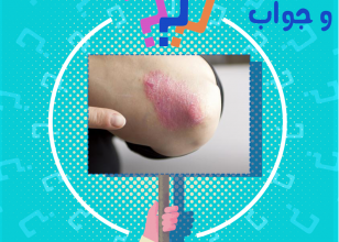 ما هى الإكزيما العصبية ؟ و ما علاجها ؟