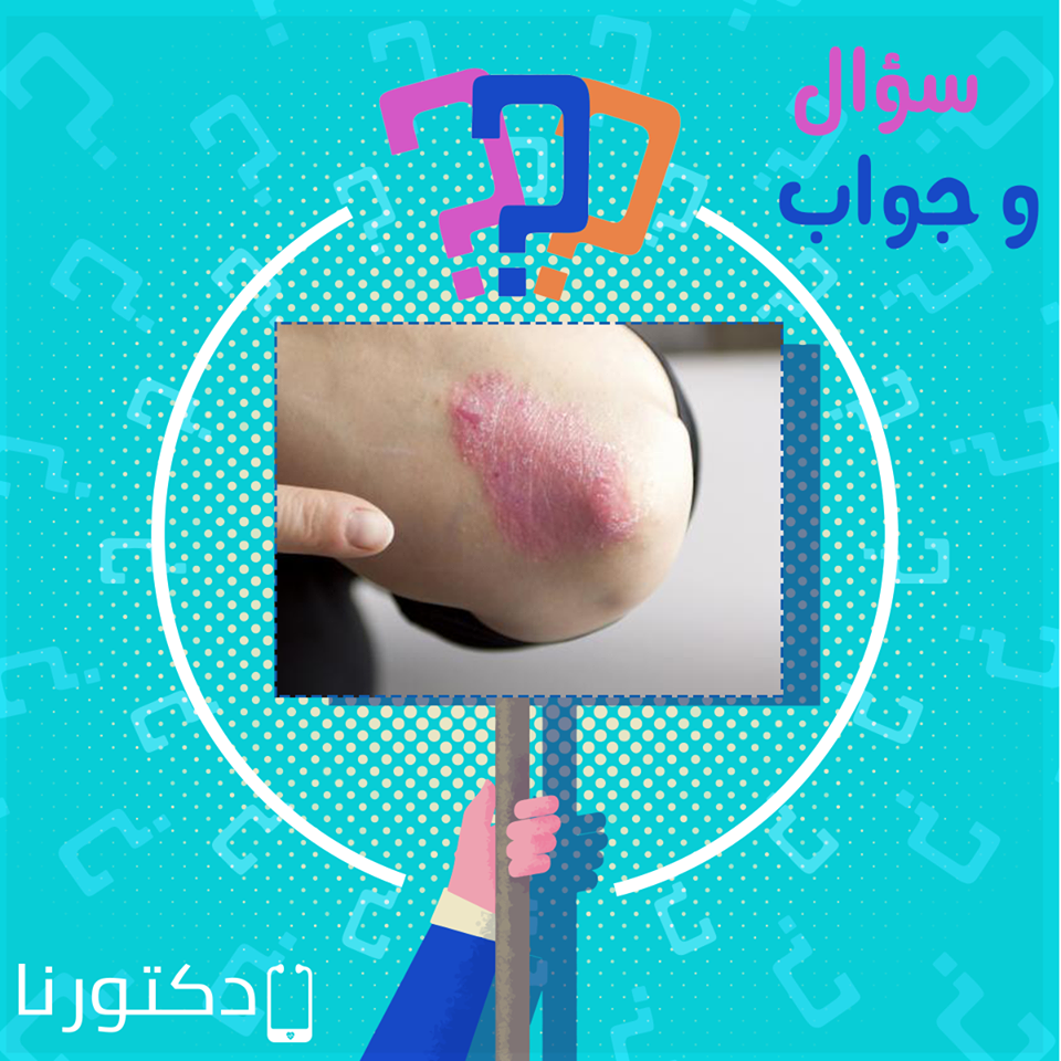 ما هى الإكزيما العصبية ؟ و ما علاجها ؟